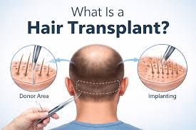 Hair transplant procedure
