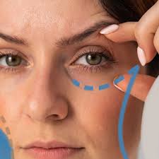 Blepharoplasty Eyelid Surgery